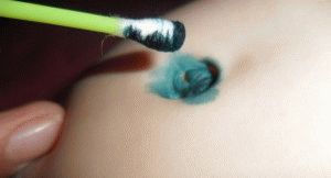 umbilical wound treatment