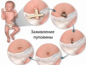 umbilical wound healing