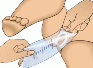 how do babies collect urine for analysis