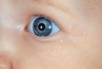 small white pimples on the face of a newborn