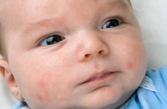 why does a newborn have acne on his face
