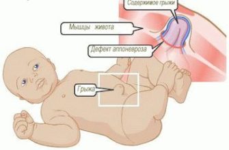 umbilical hernia in infants