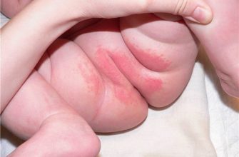 How to treat diaper rash in a newborn