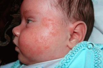symptoms of diathesis in infants