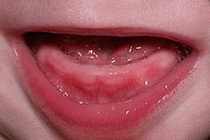 teeth are teething