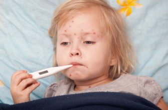 chickenpox in infants - treatment