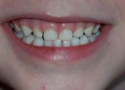 why is the child grinding his teeth