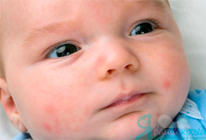 child with food allergy symptoms