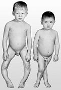 Children who have had rickets