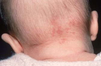 hemangioma on the back of the head in a newborn baby
