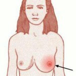 Symptoms of mastitis with gua