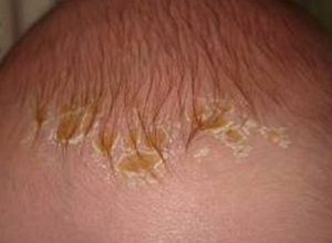 crusts on the baby's head