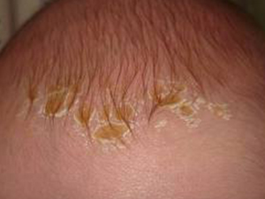 crusts on the baby's head