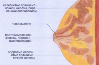 breast lactostasis