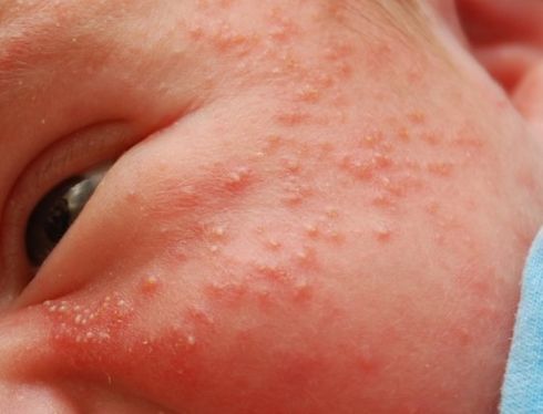acne in newborns
