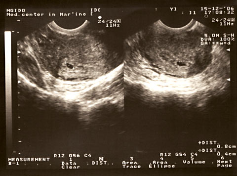 ultrasound for 3 weeks of pregnancy