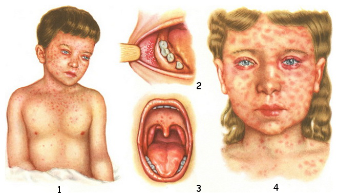 Symptoms of measles: 1 and 4 - rash; 2 - symptom of Belsky-Filatov-Koplik; 3 - enanthema in the prodromal period