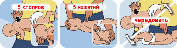 Place the baby face down on the arm so that the head is below the torso. With the base of the palm of your free hand, make 5 claps in a row between the shoulder blades of the child. After each clap, check to see if the airway obstruction has been resolved. If the foreign body cannot be removed, turn the child on his back. Put two fingers on the sternum of the child and make 5 clicks, pushing the sternum to a depth of 1-2 cm and letting the sternum straighten after each pressing, without removing the fingers from it. If these measures do not help, call the ambulance again to make sure that the call has been accepted. Before the ambulance arrives, continue to provide first aid, alternate patting on the back and squeezing the chest. If at some point the child faints, start doing artificial respiration and indirect heart massage.