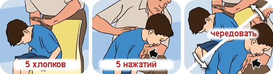 Bend the baby forward and with the base of the palm make five strong claps in a row between the shoulder blades. Between pops, check if the blockage has been fixed. If it is not possible to clear the airways, proceed to the next step. Place one hand on your back and the other in the center of your chest. Perform with your hand, which lies on the chest, 5 strong pressures, approximately as with a heart massage, but slower and sharper. If these measures do not help, call an ambulance, and before her arrival, alternate 5 claps on the back and 5 pressure on the chest.