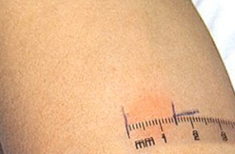 Mantoux vaccination for children