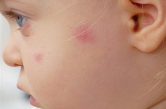 insect bites in children