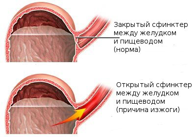 Why is there heartburn in pregnant women?