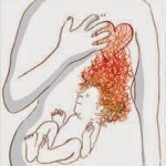 heartburn in pregnant women