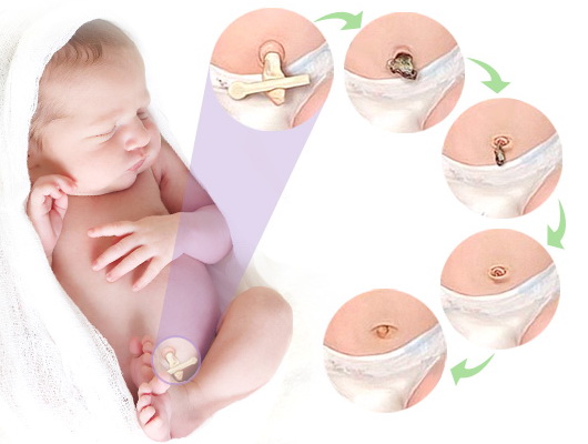 umbilical wound healing