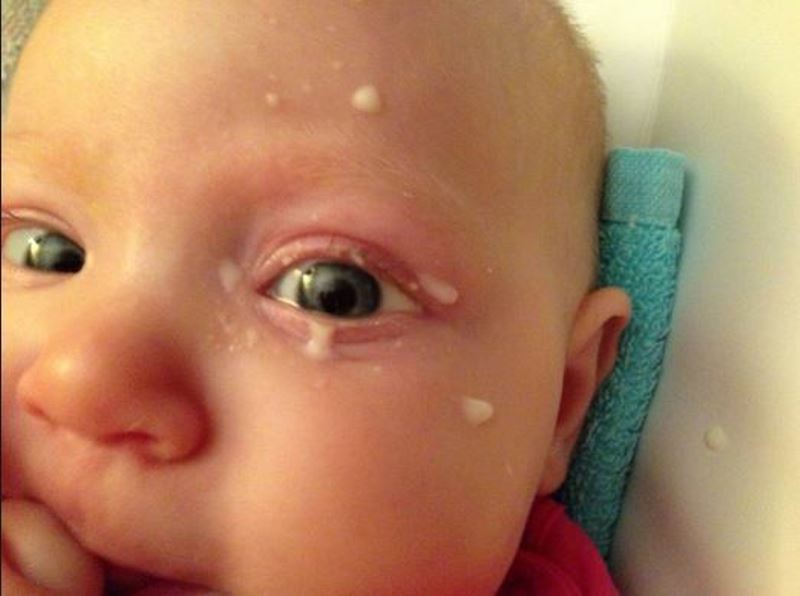 conjunctivitis breast milk