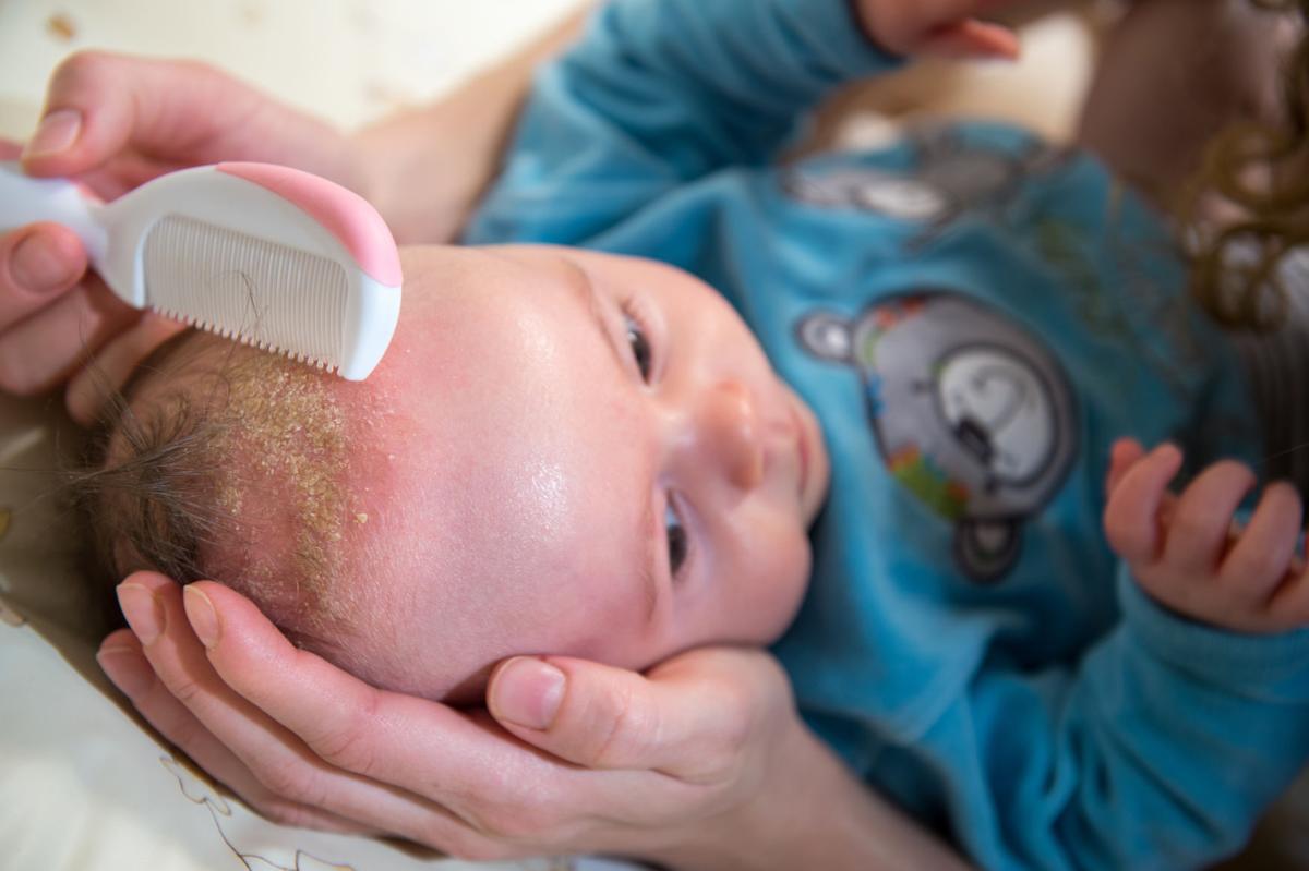 Children's seborrheic dermatitis