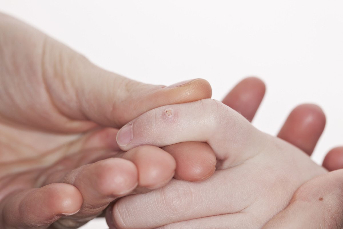 a child has warts