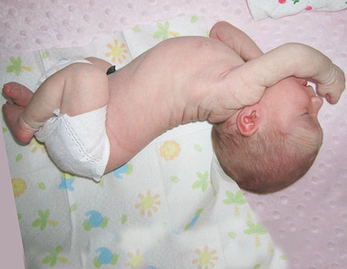 the child has febrile seizures